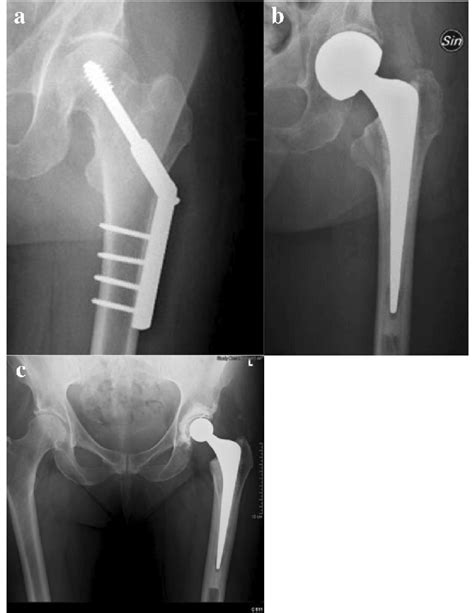 hip hemiarthroplasty orthobullets|Femoral Neck Fracture Cemented Bipolar Hemiarthroplasty.